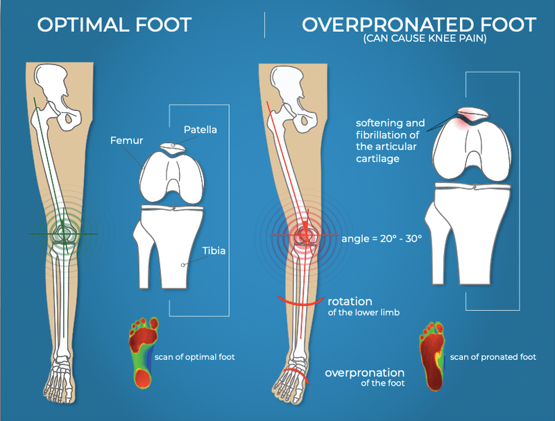 An image of the process of obtaining custom foot orthotics.